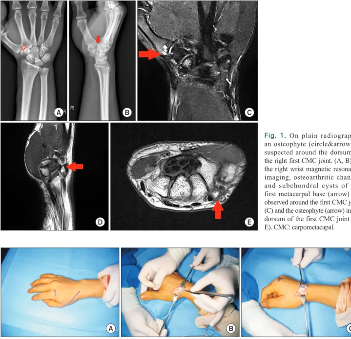 Fig.	 1.  On plain radiographs,  an osteophyte (circle&amp;arrow) is  suspected around the dorsum of  the right first CMC joint