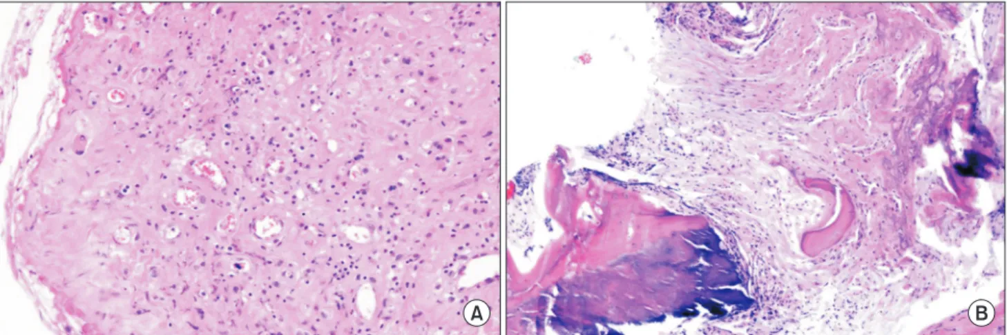 Fig.	2.  Histologic findings. (A) Granulation tissues (H&amp;E stain, ×200). (B) Ossification with chronic inflammation (H&amp;E stain, 