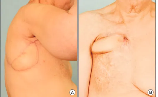 Fig.	4.  Postoperative view. (A) Ad- Ad-vanced intercostal artery perforator  flap, 2 months after surgery