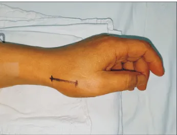 Fig.	2.  A space between extensor pollicis brevis tendon and  abductor pollicis longus tendon is identified