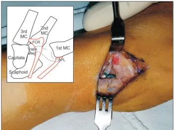 Fig.	 5.  The suture needle is passed through the abductor  pollicis longus tendon from outside to inside to the trapezial  space.