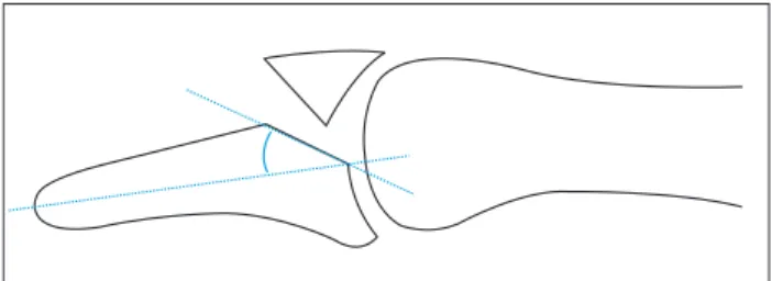 Fig.	1.  (A) Step-off was defined as more than 1 mm of displacement in the longitudinal direction