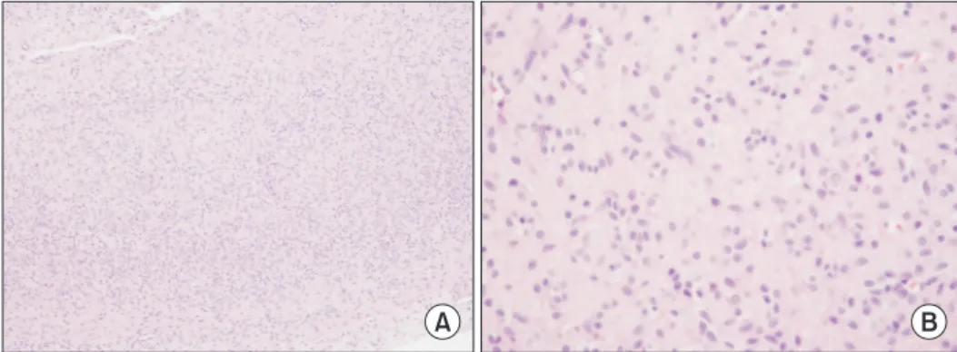 Fig.	3.  Histopathologic finding of  intratendinous fibroma. (A)  Low-power view (H&amp;E stain, ×100)  showing numerous hyalinized  fibrous tissues
