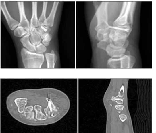 Fig.	3.  Postoperative radiograph 4  months post-surgery.