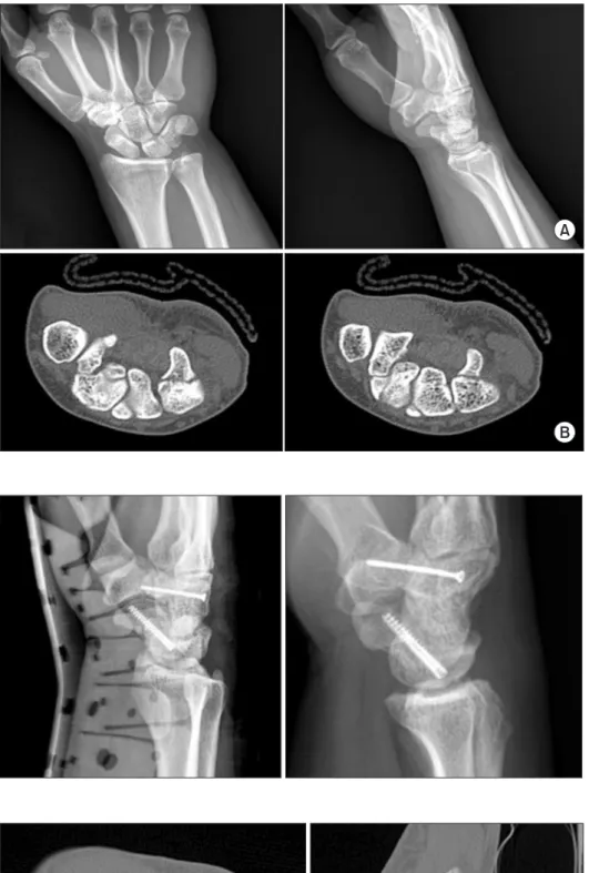 Fig.	 5.  A 45-year-old man. Pre- Pre-operative plain radiographs of left  wrist. (A) Anteroposterior and  la-teral radiographs show scaphoid  and hamate bone fracture