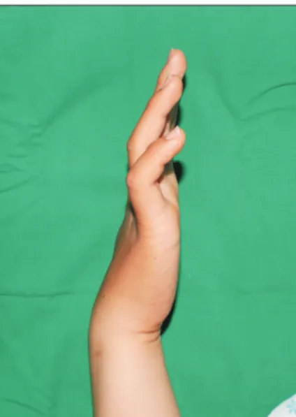 Fig.	2.  On physical examination, finger abduction and adduction is abnormal on the right hand.