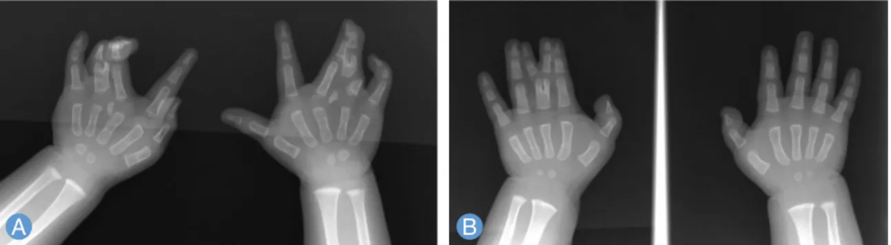 Fig. 1. Radiologic evaluation of the patients with axial type polydactyly with syndactyly (polysyndactyly) in the bilateral 4th dig- dig-its (A) and in the left 3rd finger (B).