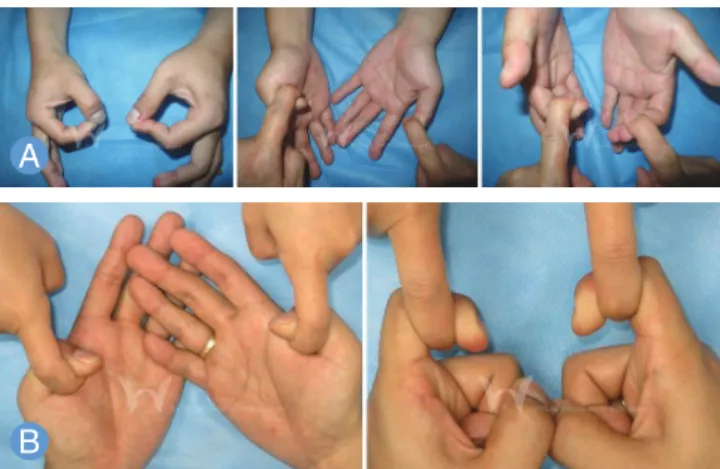 Fig. 2. In 4th case, a 26-year-old man could not flex interphalangeal  joint of thumb and distal interphalangeal joint of index finger in left  hand after lifting heavy object