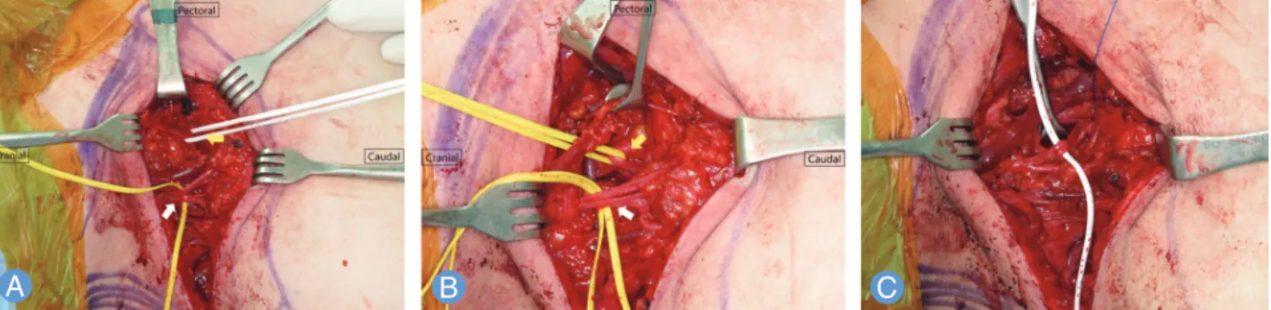 Fig. 1. Spinal accessory nerve transfer (distal motor branch) to suprascapular nerve for the patients with suprascapular nerve palsy due to  brachial plexus injury