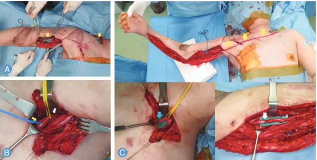 Fig. 2. This patient sustained whole arm type brachial plexus injury. His suprascapular nerve function remained, and the  intercostal nerve could not be used as a donor due to damage of the chest wall