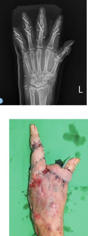 Fig. 4. Two months after orthopedic surgery, second ray was also  amputated for wound healing