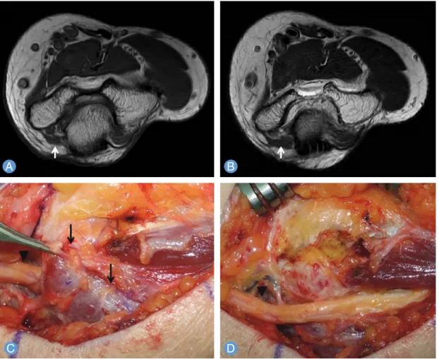 Fig. 1. A fifty-eight year-old patient had surgery for cubital tunnel syndrome. The interval from symptom development to  surgery was about 12 months and she had no atrophy of intrinsic muscle of her left hand