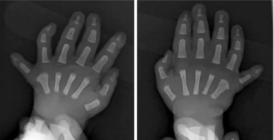 Fig. 2. On the radiograph of both hands, 5th metacarpal head is wide.