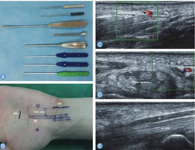 Fig. 4. The safe line is defined as midline between the ulnar  margin of the median nerve and the radial margin of the ulnar  artery