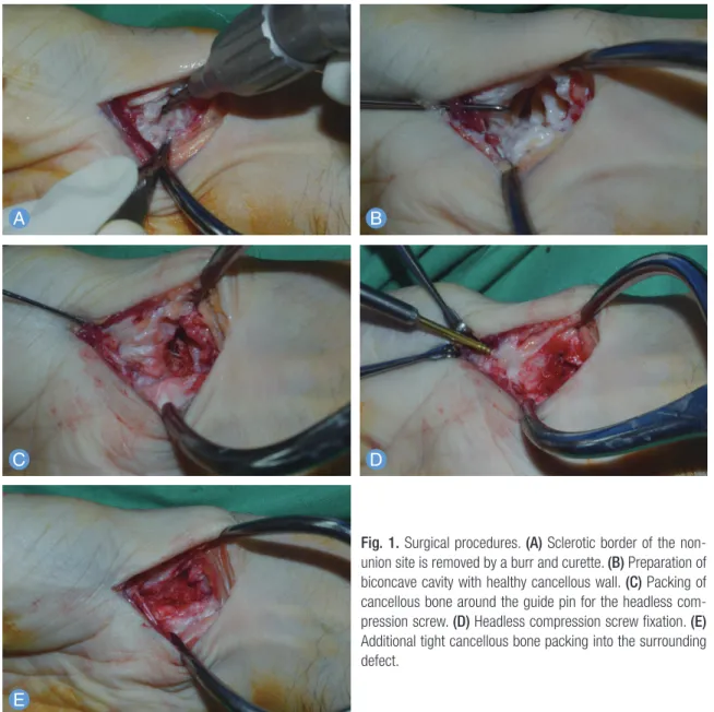 Fig. 1. Surgical procedures. (A) Sclerotic border of the non­