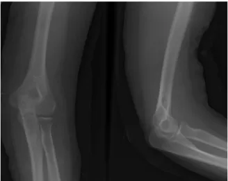 Fig. 3. (A, B) Postoperative radiograph and sagittal plane views of computed tomography scan shows open reduction and  internal fixation with cancellous screw