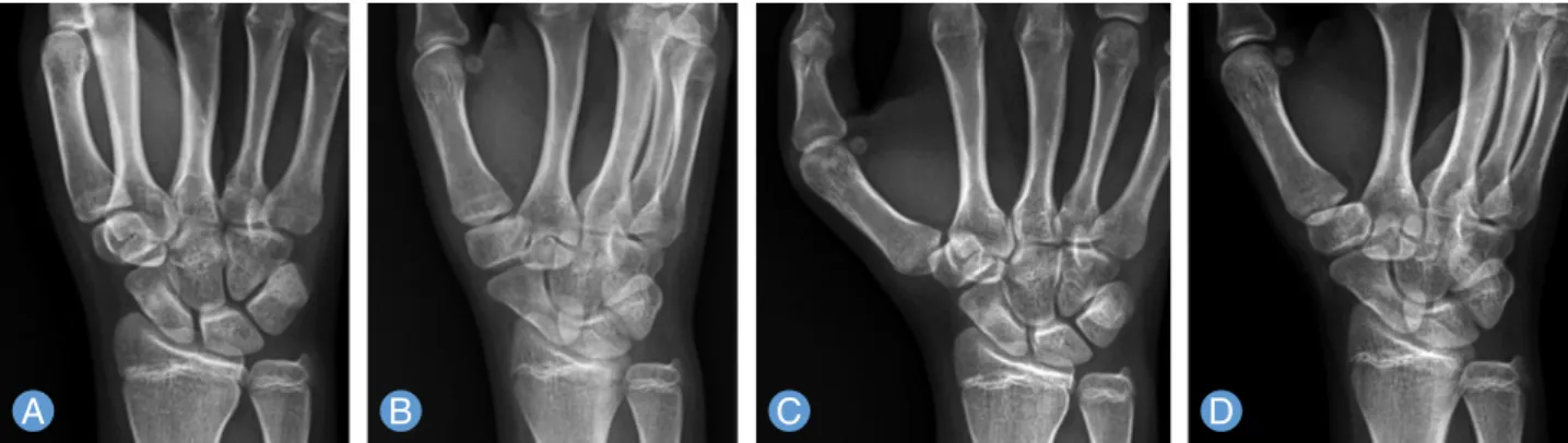 Fig. 3. Two dimensional computed tomography coronal im- im-age suggested an air density (arrow) in the carpometacarpal  joint of the thumb.