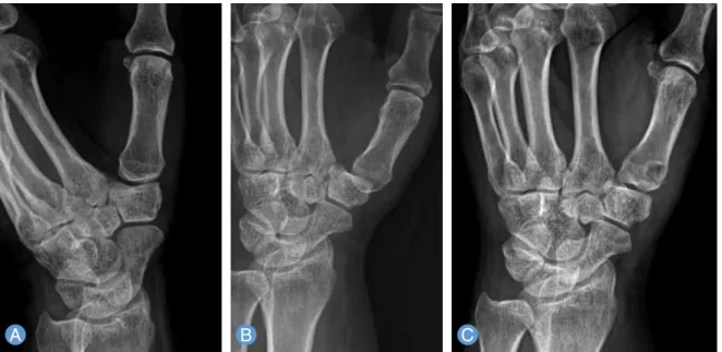 Fig. 8. (A) Plain radiograph made after injury showed normal alignment of the carpometacarpal joint of the thumb with uniform  joint space