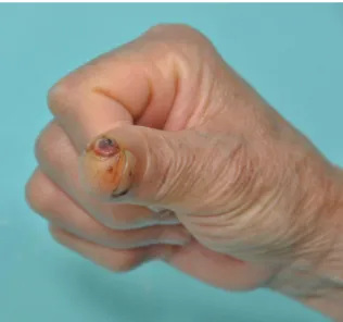 Fig. 1. Preoperative view. The lesion was 5 mm in diameter  and its surface was red and dark color, ulcerated.