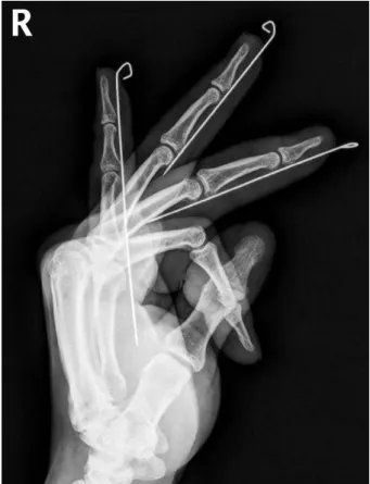 Fig. 1. A postoperative X-ray after Kirschner wire insertion through the soft tissue. The wires placed on the volar side of the right third, fourth, and fifth fingers are immobilized in full  exten-sion and are inserted up to the proximal third of the thir