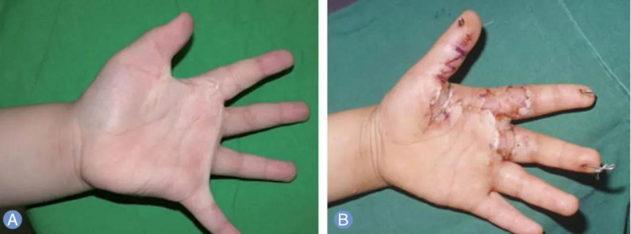 Fig. 3. Case 2. (A) A 6-year-old child with burn scar contracture on the first, second, and third web spaces and fingers of the left hand