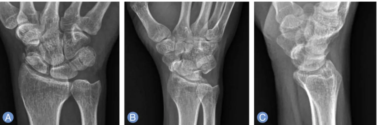 Fig. 2. (A, B) Intraoperative view. Attritional ruptured of Flexor pollicis longus was caused protruded fragment through rup- rup-ture in the volar capsule