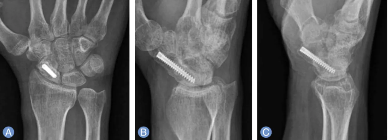 Fig. 3. (A-C) Postoperative radiography. Bone union obtained after 3 months.