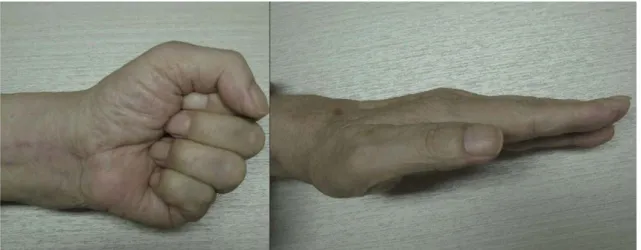Fig. 6. Index finger has a good active flexion and extension function.
