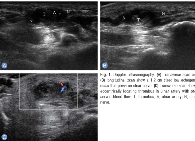 Fig. 2. Intraoperative photography shows oval-shaped mass on ulnar artery. This mass compress and adherent to ulnar nerve.
