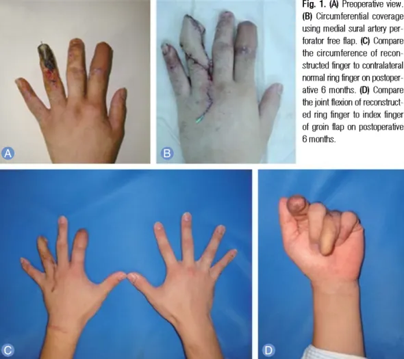 Fig. 1. (A) Preoperative view.