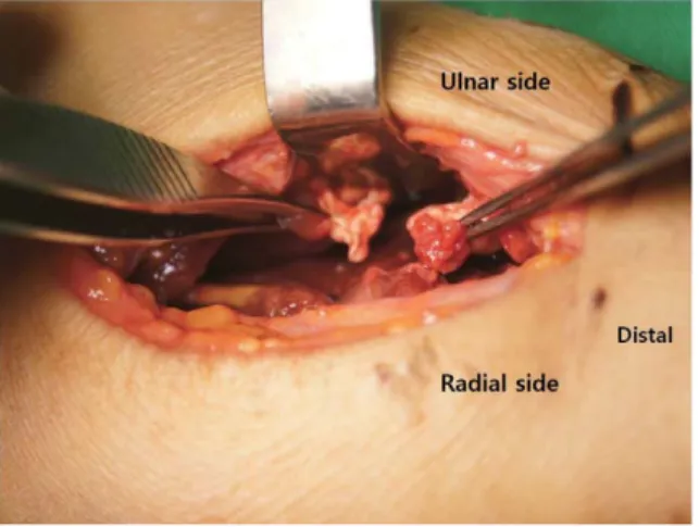 Fig. 3. Intraoperative gross picture showing repaired tendon (black arrow) using the modified Kessler technique and a  run-ning epitendinous suture for reinforcement.