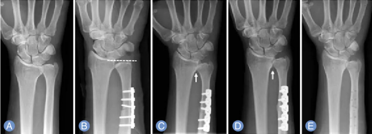 Fig. 3. The patient has been complaining with a left wrist pain for five months. (A) The radiograph showed 5 mm ulnar positive variance and sigmoid notch tilt to ulnar side (type I)