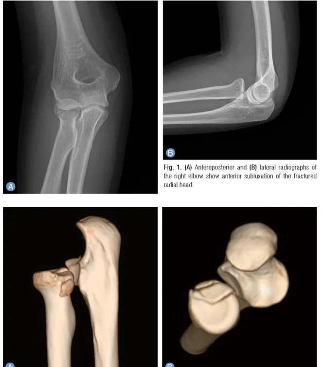 Fig. 2. (A, B) Preoperative 3-dimensional computed tomography image shows radial head fracture and comminuted frag- frag-ment, which displaced posteriorly and distally, and anterior subluxation of radial head.