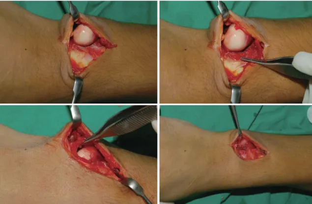 Fig. 3. Sequence of reduction and repair of impinged triangular fibrocartilage complex.