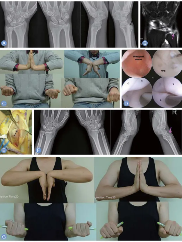 Fig. 2. Case of patient presenting with persisted ulnar side wrist pain after the initial injury 5 years ago