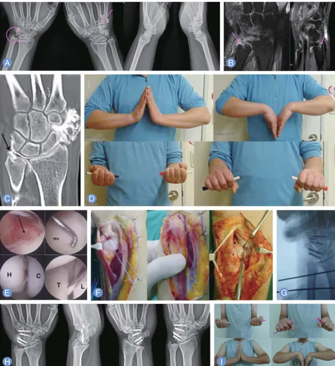 Fig. 3. Case of patient presenting with persisted ulnar side wrist pain after the initial injury 6 months ago despite of the initial conservative man- man-agement using long arm cast for 4 weeks