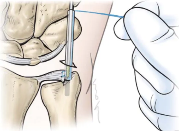 Fig. 6. Arthroscopic view shows the anchor being advanced into the predilled hole.