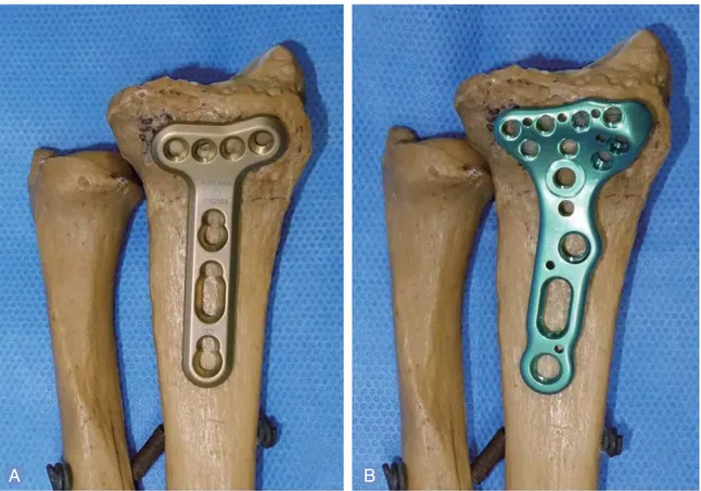 Fig. 1. Volar locking plates used in this study. (A) LCP volar extra-articular distal radius plate (DePuySynthes, West Chester, PA, USA) with single row of 4 or 5 distal locking screws