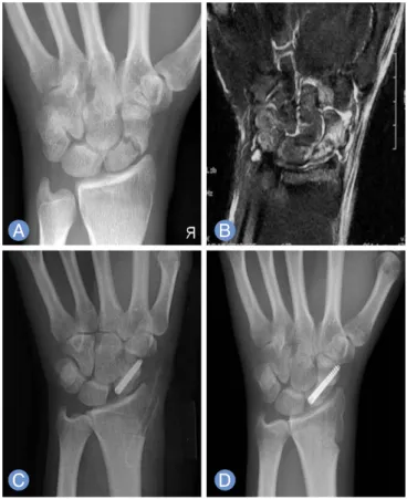 Fig. 2. The patient with a complaining of right wrist pain for 1 year.