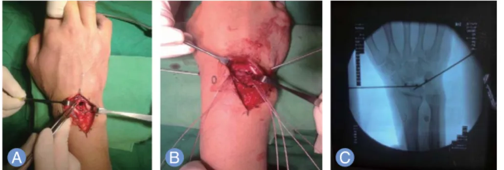 Fig. 3. Intraoperative find- find-ing. (A) Pre-reduction. (B) Post-reduction. (C)  Intra-operative X-ray finding with anchor suture and  K-wire fixation.