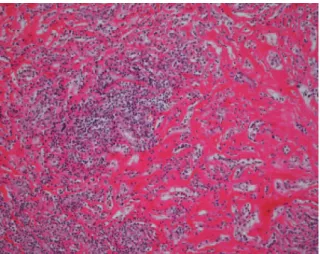 Fig. 1. A 56-year-old male has a movable, non-tender nod- nod-ule on left elbow.
