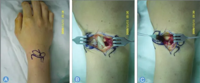 Fig. 1. (A) Skin incition. (B) The extensor retinaculum between second and third extensor compartment is incised