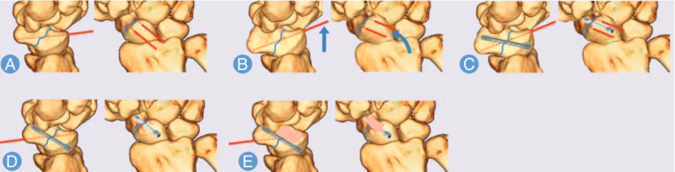 Fig. 3. (A) 0.045 K-wire are inserted perpendicularly to the central axis of the scaphoid into the proximal and distal scaphoid fragments