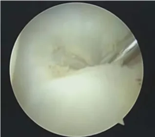Fig. 1. Hook test. The triangular fibrocartilage complex is ele- ele-vated by pulling with probe beneath.