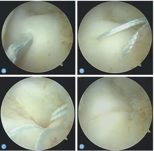 Fig. 3. Arthroscopic repair technique. (A) A needle loaded with thread penetrates the triangular fibrocartilage complex (TFCC) from outside