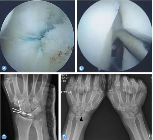 Fig. 5. Forty-seven-year-old man. (A) The picture of the repair of triangular fibrocartilage complex IB tear