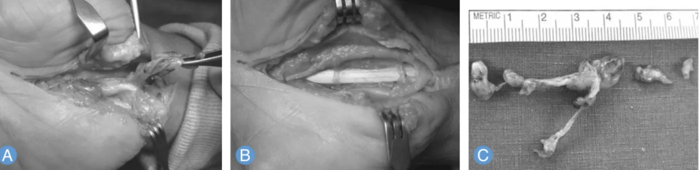 Fig. 2. (A) Irregularly shaped nodular and streaky portion of the mass was freely separated from the tendon