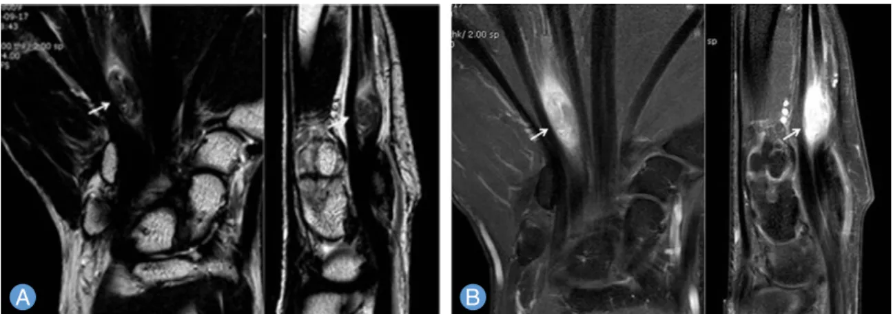 Fig. 5. (A) Round gray mass was identified underneath transverse carpal ligament, which was originated from flexor digito- digito-rum profundus and connected lumbrical muscle