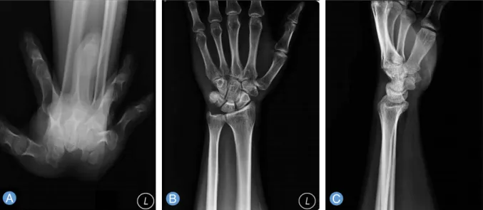Fig. 2. (A) The tumor associated with the flexor digitorum profundus tendon of 5th finger