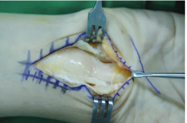 Fig. 4. Intraoperative finding of median nerve. Severe steno- steno-sis in carpal tunnel and compression median nerve just below retinaculum is noted.